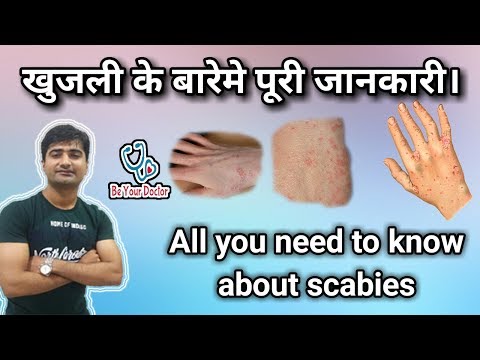 हिन्दी - खुजली | Scabies | Life cycle | Symptoms | Complication | Treatment | Prevention Video