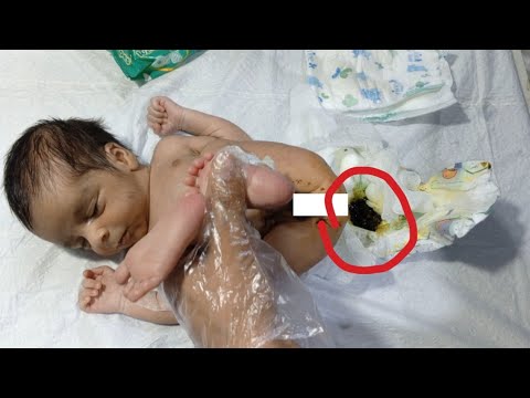 Abdominal Distension Relief in Newborn | Micronema Insertion Procedure | NICU Neonatal Care