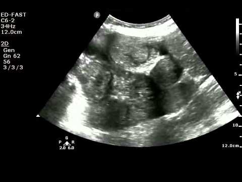 Small bowel obstruction on ultrasound