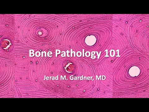 Bone Tumor Pathology 101: Osteosarcoma, Chondrosarcoma, and Mimics