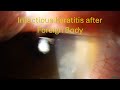 0095: Infectious Keratitis after Foreign Body