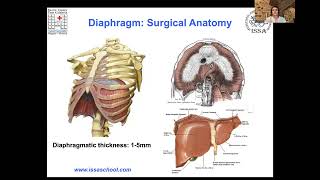 EEL Webinar: The diagnostic and therapy of diaphragmatic endometriosis - Roberto Clarizia/Taner Usta