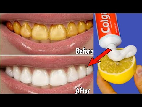 Teeth whitening and tartar drop in one minute, remove yellowing and make teeth white and clear