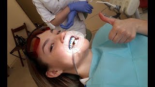 Отбеливание зубов Belle Whitening: видео