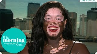 I&#39;m a Black Woman Slowly Turning White | This Morning