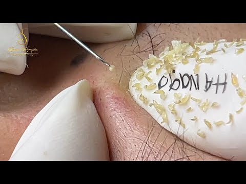 Loan Nguyen Acne Treatment (#153)