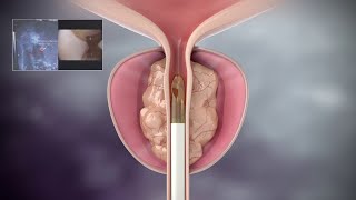 Rezum Prostate Surgery with 3D Animation