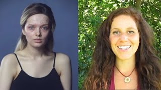 YOU LOOK DISGUSTING - My Response & Acne Struggle | 40BelowFruity