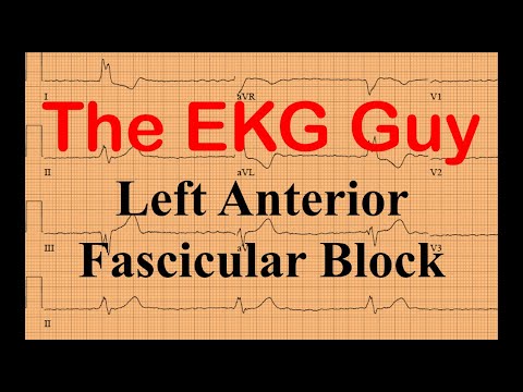 EKG/ECG Practice 65.0 - Left Anterior Fascicular Block | The EKG Guy