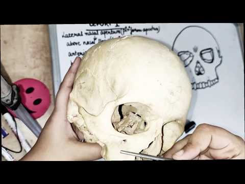 lefort 1 fracture - line and clinical features