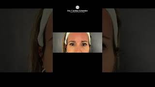 Tratamiento para OJERAS ANTES Y DESPUES