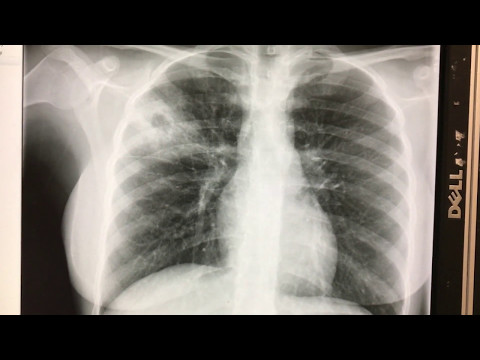 wow...what is that on this chest x-ray?