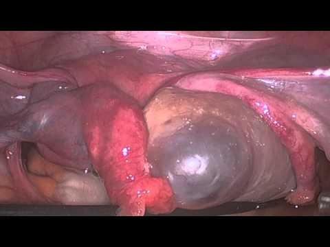 Laparoscopic Management of Ovarian Torsion
