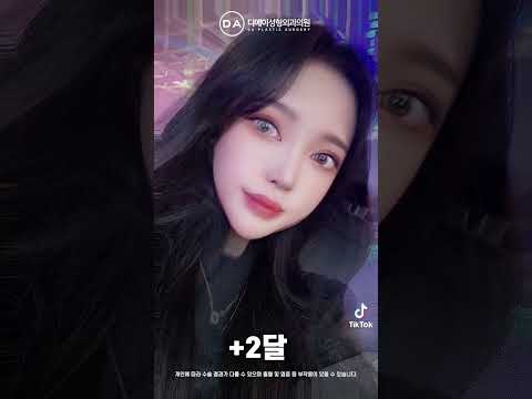 미니리프팅+절개눈매