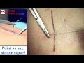 Technique point suture simple séparé par SoinsDomicile.ma