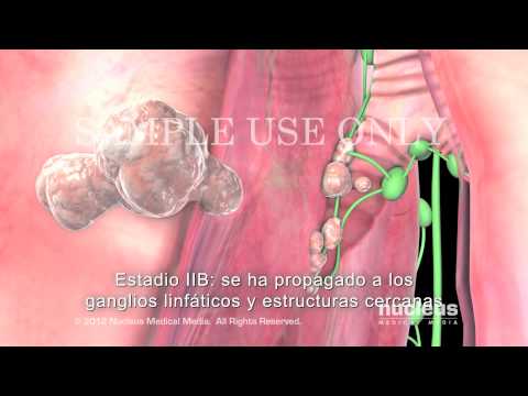 Progreso y estadificación del cáncer de pulmón