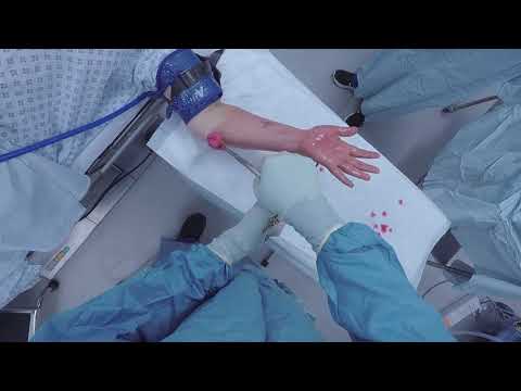 cubitalis alagút szindróma műtét videó