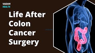 Life After Colon Cancer Surgery