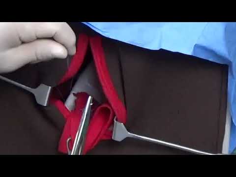 PPH Exercise 3 Laceration of Uterine Cervix v8 30