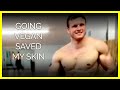 Going Vegan Cleared my Acne | Body Builder Brian Turner