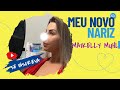 Minha Tão Sonhada Rinoplastia Cirurgia Estética No Nariz Veja O Antes E Depois