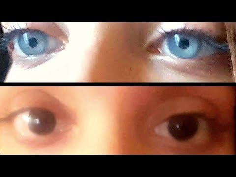 BrightOcular - Behind the Implant: An Interview with a Patient #2