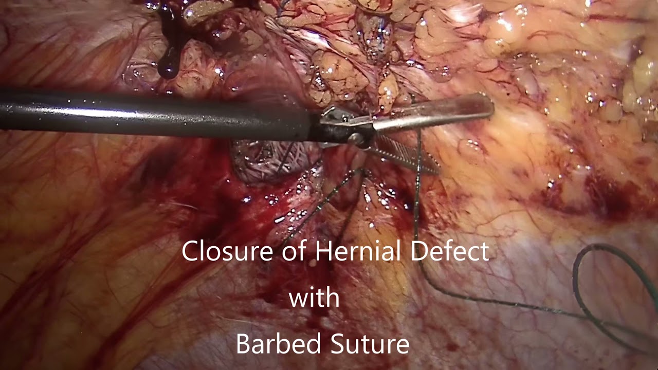 IPOM Plus Ventral Hernia