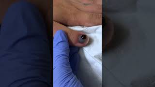 Trephination of a Fingernail Subungual Hematoma with Cautery