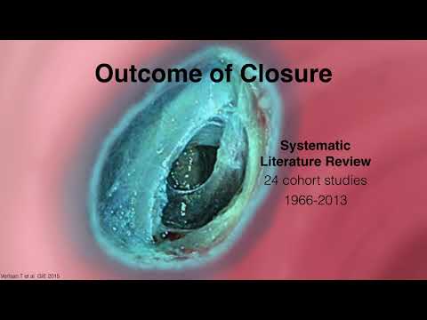 Colonoscopy: Colon Perforation Closure Talk at TSGE 2017