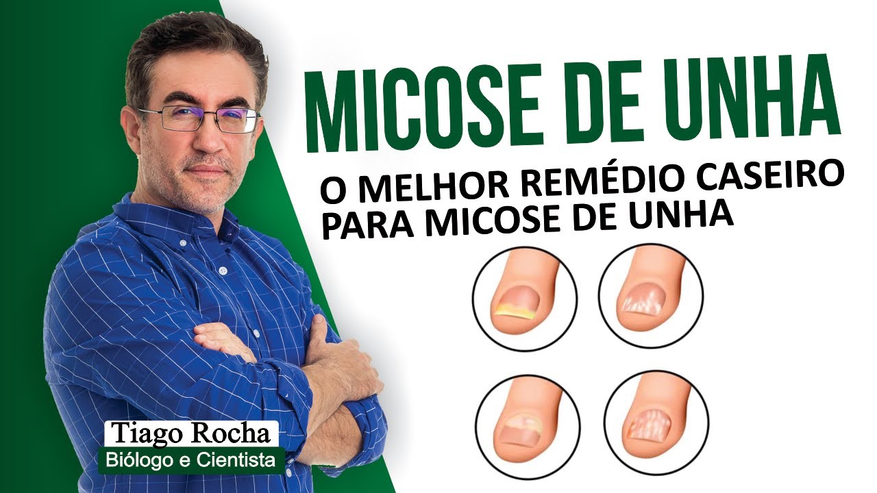 O melhor REMÉDIO CASEIRO para MICOSE DE UNHA.