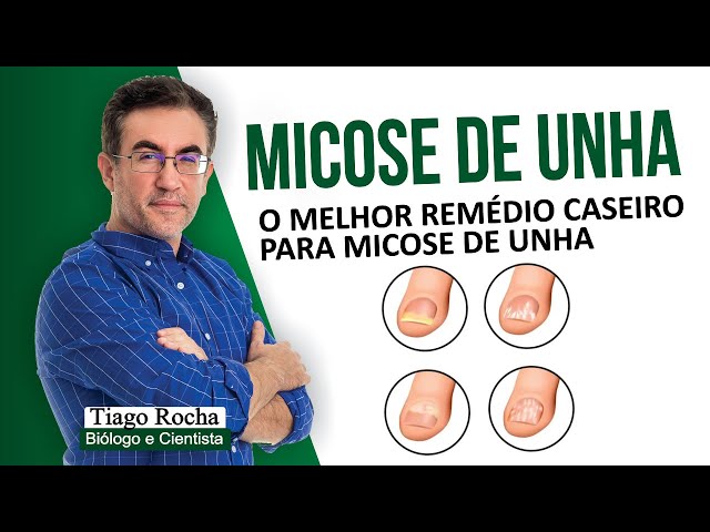O melhor REMÉDIO CASEIRO para MICOSE DE UNHA.