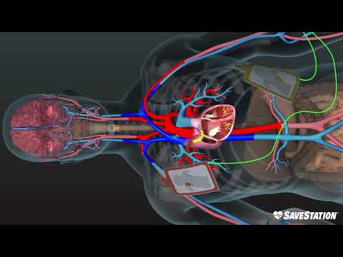 AED in Action | A 3D look inside the body