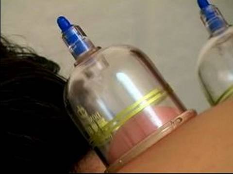 What is Chinese Medicine? : Chinese Medicine Cupping Treatment