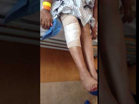 Unilateral Total Knee Replacement — Patient Video