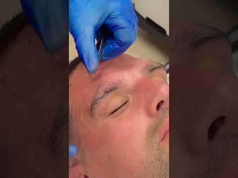 Skin Tag Removal on Eyelid Melbourne