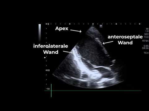 Echocardiography: apical 2- and 3-chamber view