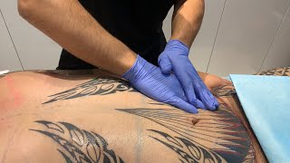 Lymphatic Massage AFTER MALE TUMMY TUCK AND BODY LIPOSUCTION | West Hollywood, CA | Dr. Jason Emer