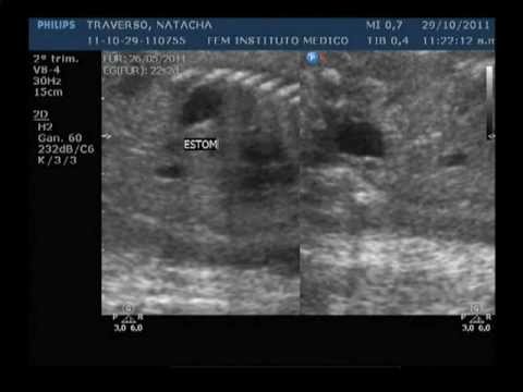 Emilia, ecografia 29-10-2011