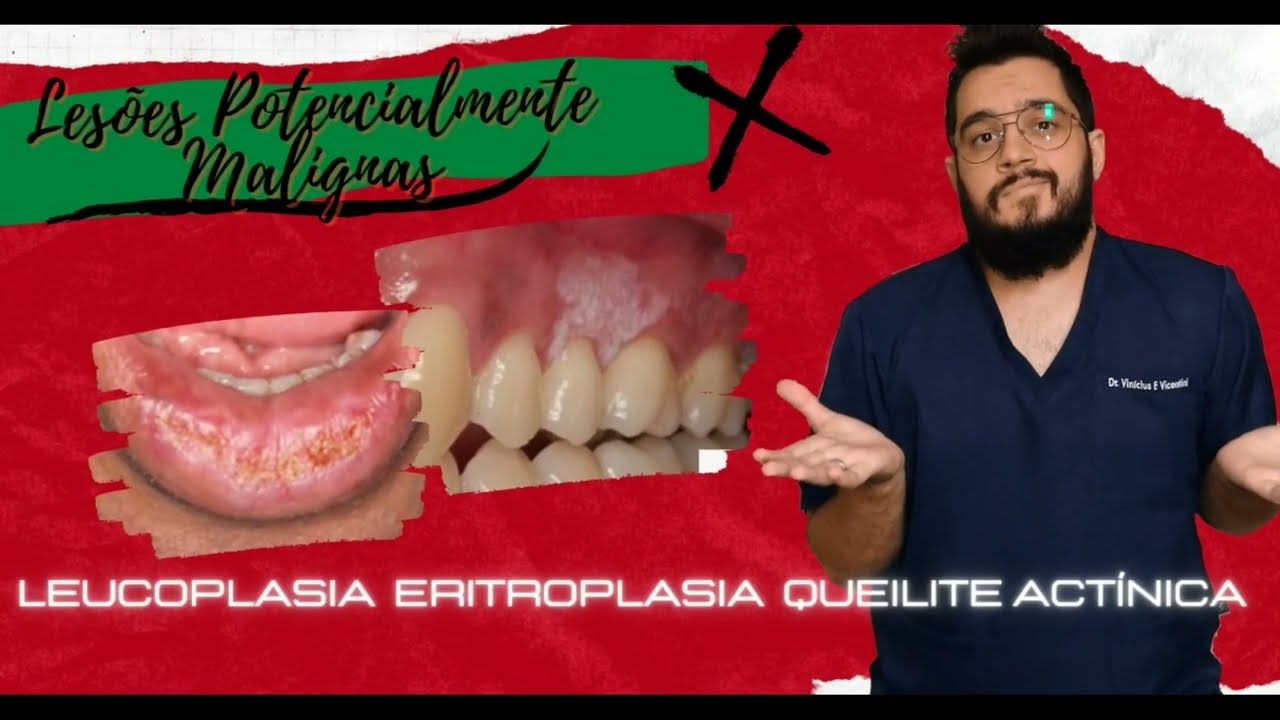 Lesões Potencialmente Malignas (Leucoplasia,Eritroplasia,Queilite Actínica)