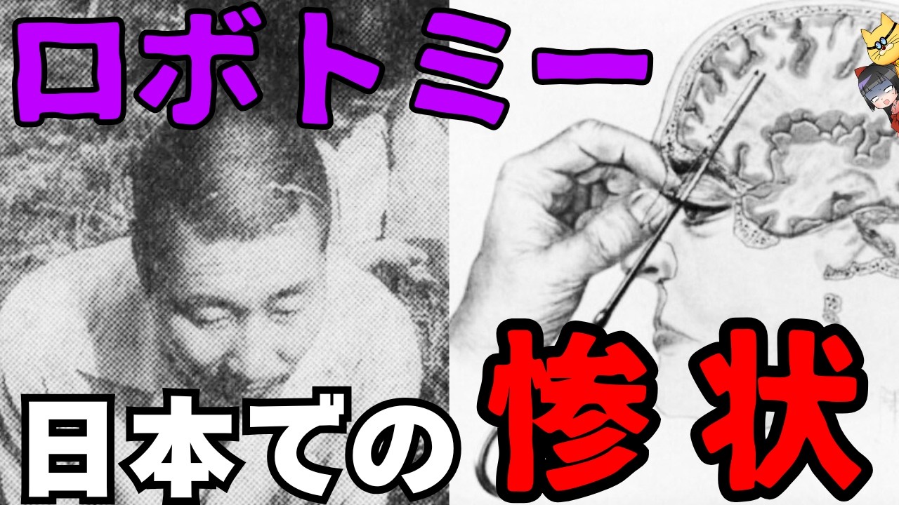 【ロボトミー手術】日本での悲惨な事例