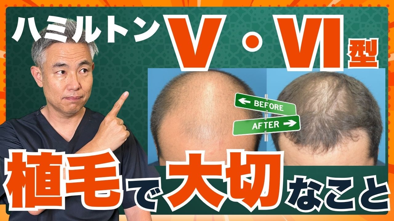 【ハミルトンⅤ・Ⅵ型】重度AGAの植毛で一番大切なこと
