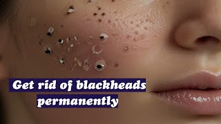 Sickening, unsightly blackheads, tweezing, acne treatment,