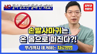 손발사마귀 건드리지 마세요! 제거방법 #족저사마귀 #편평사마귀 #HPV 면역치료