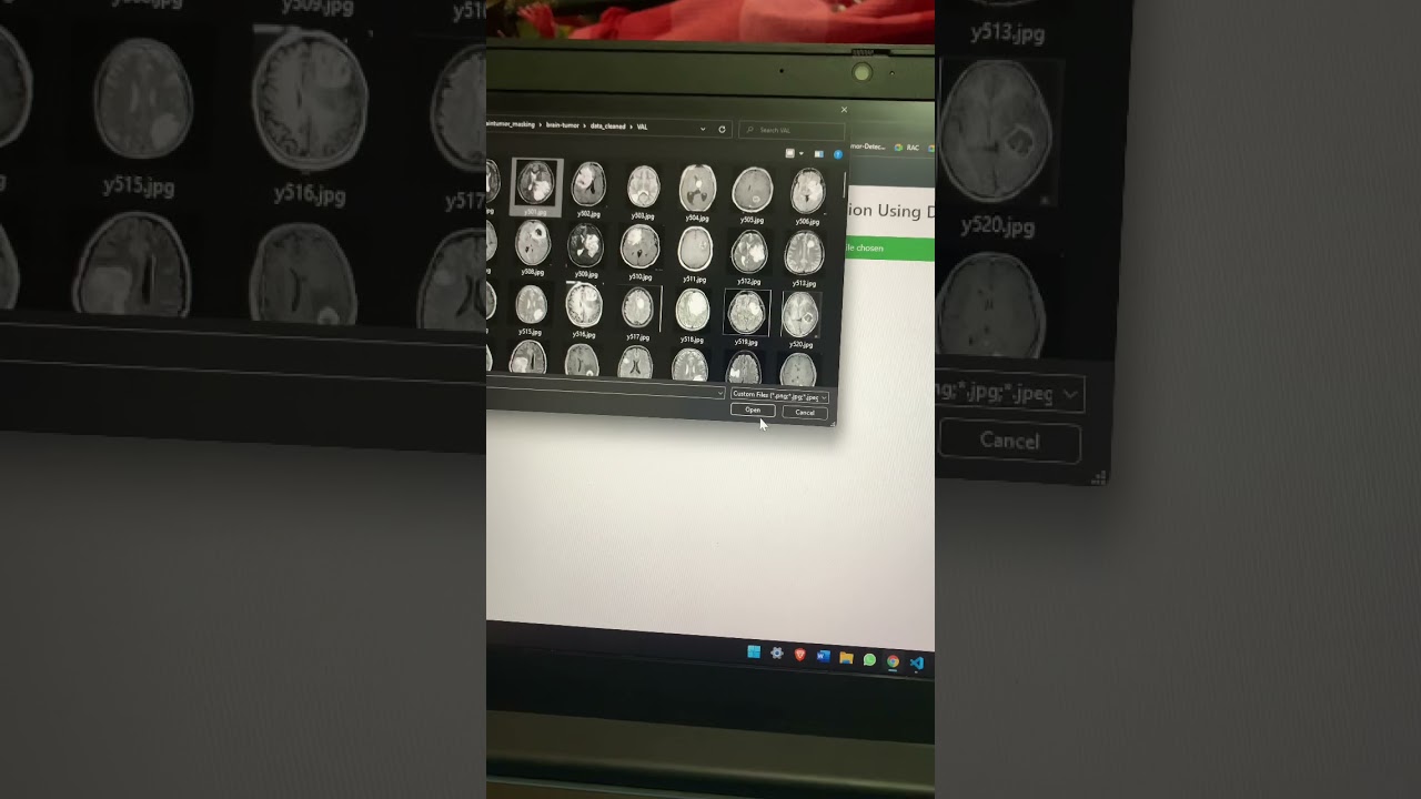 BRAIN TUMOR DETECTION USING DEEP LEARNING