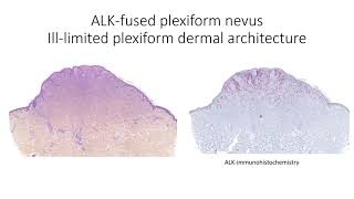 ALK-fused plexiform Spitz nevus: morphological clues in the #NonAIpath program