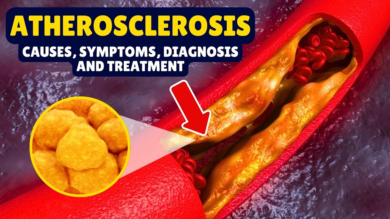 What is Atherosclerosis? Causes, Signs and Symptoms, Diagnosis & Treatment