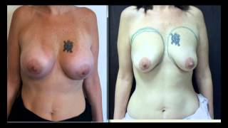 ד"ר אבישי וינברגר - תמונות לפני ואחרי ניתוח הגדלת חזה