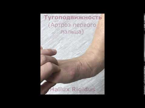 Нпвс при грыже шейного отдела позвоночника Хондроитин лечение суставов
