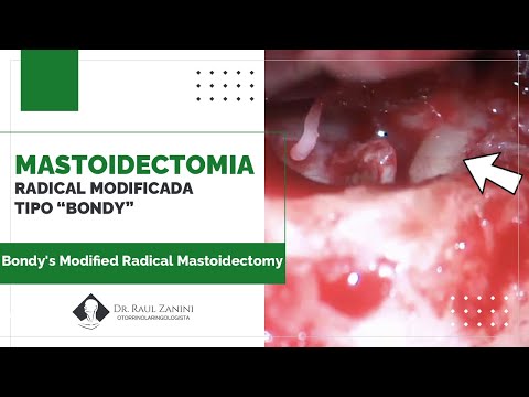 Miniatura: Mastoidectomia Radical Modificada Tipo Bondy