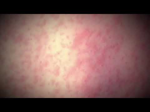 Rockland Measles